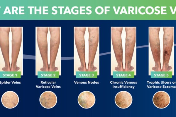 Chronic venous insufficiency Chronic venous insufficiency