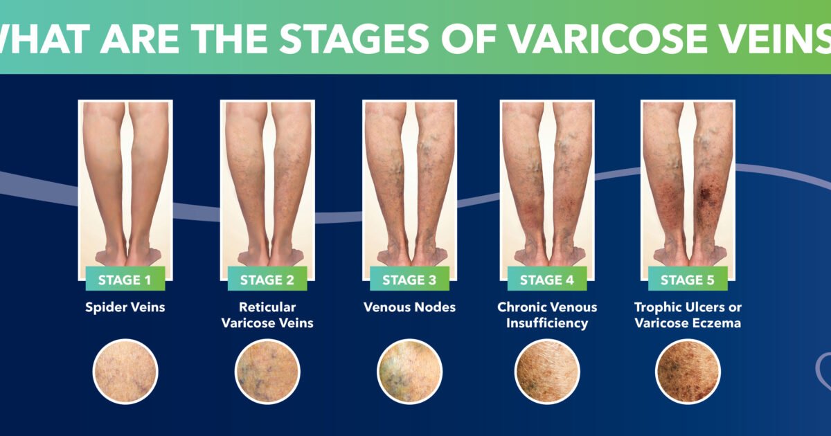 Chronic venous insufficiency